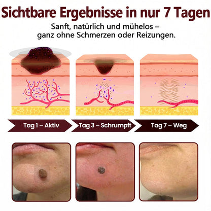 KUBOZN® OryzaDarts TAG’GONE – Schmerzfreie Entfernung an der Wurzel dank Schwarzer-Reis-Mikrotechnologie ✨  (offer)