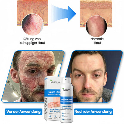 ✅KUBOZN® Neuro-Calm Anti-Juckreiz Akut-Spray – 3-Minuten-Ruhe bei Juckreiz (offer)
